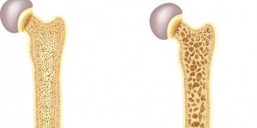 Menopause And Osteoporosis: What Every Menopausal Woman Should Know To Boost Her Bone Health